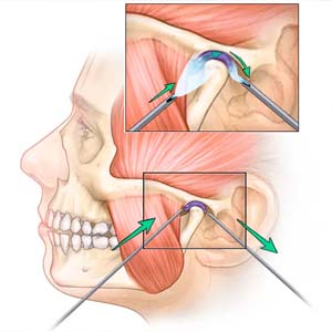 TM Joint Pain Removal