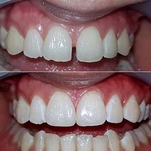 Diastema Closure
