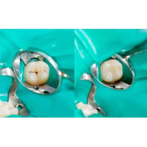 Cosmetic Tooth Filling