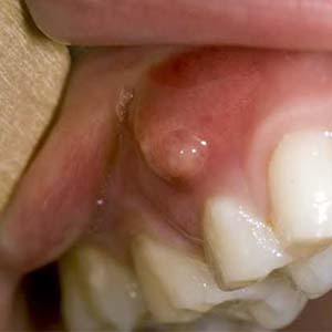 Cyst Removal